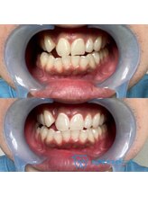 おうちサロン しゅろ/プレミアムセルフホワイトニング