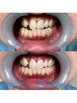 おうちサロン しゅろ/プレミアムセルフホワイトニング