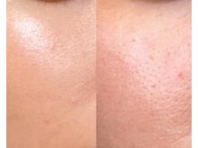 ルミエール シーサイド(L’MIERE seaside)/毛穴開きをキュッと引き締め