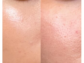 ルミエール シーサイド(L’MIERE seaside)/毛穴開きをキュッと引き締め