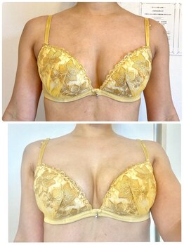 美人バスト 沼津店/【バストアップ★育乳】症例！！