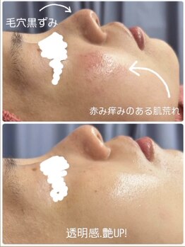 ビガク(BIGAKU)/敏感肌で不安定な肌荒れにも◎