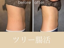 チャームズ(CHARM'S)/お腹before→after