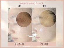 シンスプラス(SINCE+)/ニキビ集中改善コース