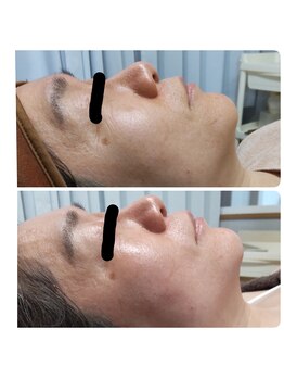 ステイ(STAY)/セルフシェーブでここまでなる?!