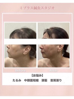 ミプラス鍼灸スタジオ/ビフォーアフター