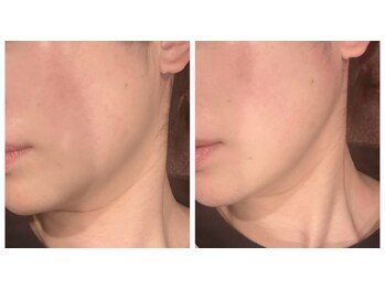 ビューティースタイリング 自由が丘店(beauty styling)の写真/【プラチナの力×最新光美容器NIR LUXS】でお肌のハリを取り戻す!!30代からのフェイシャルケアに◎