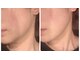 ビューティースタイリング 自由が丘店(beauty styling)の写真/【プラチナの力×最新光美容器NIR LUXS】でお肌のハリを取り戻す!!30代からのフェイシャルケアに◎