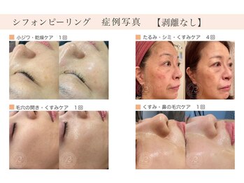 ビジョイ(Bejoy)/リベルシフォンピーリング