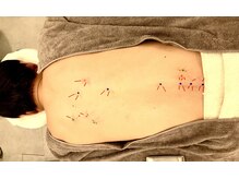 銀座鍼処 カナウ(KANAU)/経絡（ツボ）で自律神経調整