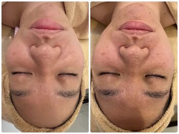 リセットラボ 本店(Reset Lab)/♪ハーブオフピーリング♪