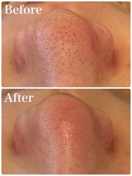 モテ 新宿店(Mote)/ハイドラ毛穴洗浄＋艶肌Wax 新宿