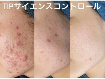 エル(Elle)/ハーブピーリング　経過