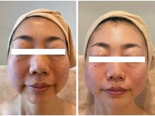 ルヴィアン 流山おおたかの森店(LUVIAN)/生ヒト幹細胞×ハンドマッサージ