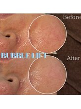 ザ ピーチ(THE PEACH)/選べるピーリング×肌質改善LDM