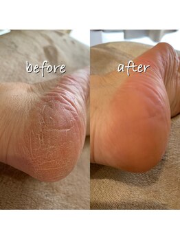 アンベリィ(In bellir)/＊フットケア＊