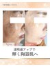 【シミケア】本気の肌質改善・小顔/白玉ピーリング導入￥23,200→￥11,000