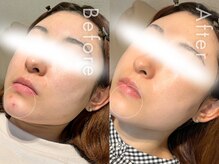 セルフミー 恵比寿(SELF Me...)/ハーブピーリング/ニキビケア