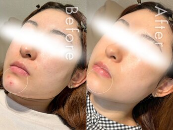 セルフミー 恵比寿(SELF Me...)/ハーブピーリング/ニキビケア