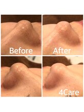 フォーケア(4Care)/ハイドロスキン