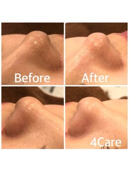 フォーケア(4Care)/ハイドロスキン