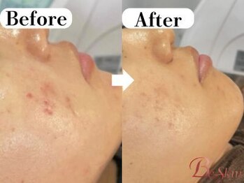 ビースキン 広島(BE:SKIN)/ハーブピーリング/ニキビケア