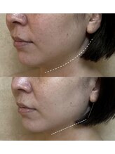 リフテグレース(LIFTE Grace)/3回施術