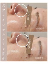 リブラン(Libran)/3ヶ月でシミがこんなに薄く♪