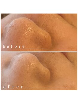 メナードフェイシャルサロン 岐阜茜部/毛穴ケア/肌荒れ/ブライダル