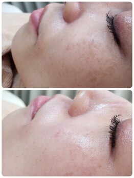 プトゥリ(Putri)/ツルスベ!フェイシャル脱毛