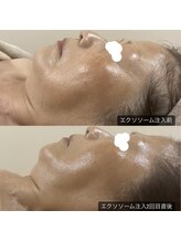 グラン ジュテ/臍帯エクソソーム注入