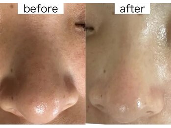 プルティティア(Pultitia)/毛穴洗浄