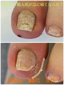 巻き爪じゅん 千葉駅前店/巻き爪・陥入爪急に痛くなった！