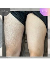 バーン 長崎 諫早(BURN)/脱毛beforeafter