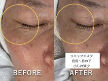 ラカ 明石(Laka)/目元、目尻のシワ・頬の赤み