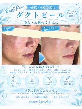 ルベル(Luvelle)の写真/「毛穴・ニキビ・くすみをまとめてケア。肌質改善ダクトピール」