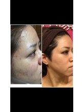 リコリナ(LikoLina)/陶肌トリートメント