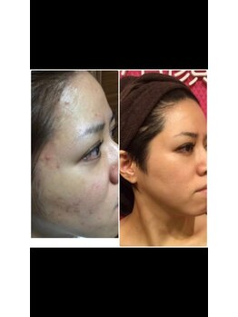 リコリナ(LikoLina)/陶肌トリートメント