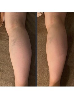 プルトア/浮腫みすぎているほど変化が！