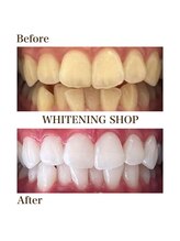 ホワイトニングショップ 一関店/9回照射後のbefore→after
