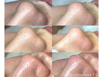 ジプソフィラフィフティドット(gypsophira15.)/毛穴洗浄でもダメだった方へ