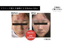 トモニ(TOMONI)/神経幹細胞×エクソソーム導入