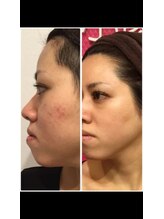 リコリナ(LikoLina)/陶肌トリートメント