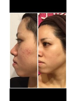 リコリナ(LikoLina)/陶肌トリートメント