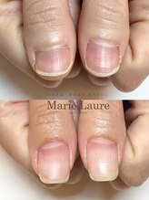 マリーロール 梅田店(Marie Laure)/深爪矯正/自爪育成/自爪風