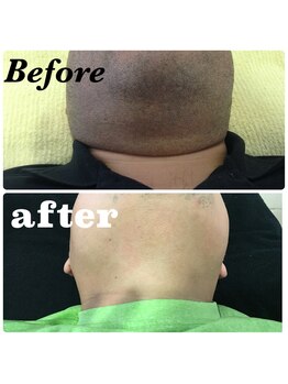 ひとつno武器/メンズヒゲ脱毛