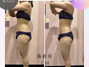 ルピナス ヒサヤ(LUPINUS hisaya)/Vシェイプ痩身