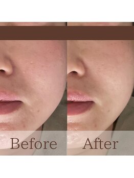 凪眠/たるみ改善ラジオ波フェイシャル