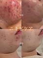 カレンジェビューティー(CarengeBeauty)&nbsp;正しい肌管理で、ニキビの出来にくいお肌を目指しましょう☆