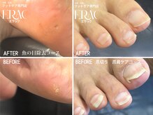 エラック 大阪本店(ERAC)の雰囲気(【施術中はリラックス】魚の目除去・爪切り )